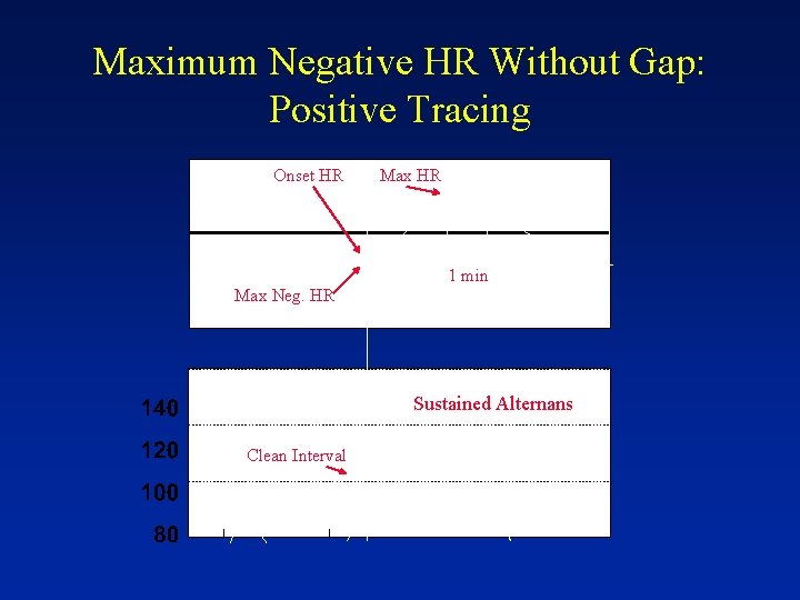 Maximum Negative HR Without Gap: Positive Tracing Onset HR Max HR 1 min Max