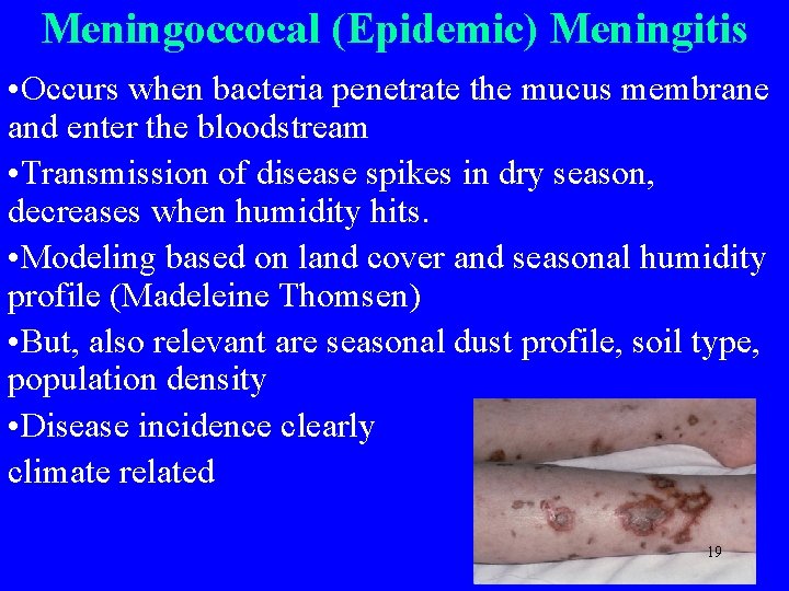 Meningoccocal (Epidemic) Meningitis • Occurs when bacteria penetrate the mucus membrane and enter the