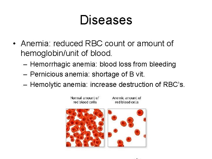 Diseases • Anemia: reduced RBC count or amount of hemoglobin/unit of blood. – Hemorrhagic