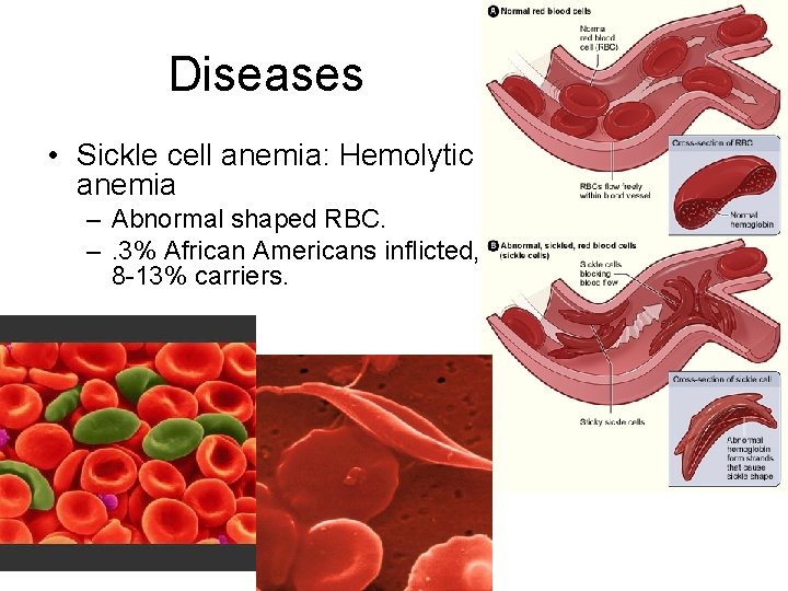 Diseases • Sickle cell anemia: Hemolytic anemia – Abnormal shaped RBC. –. 3% African