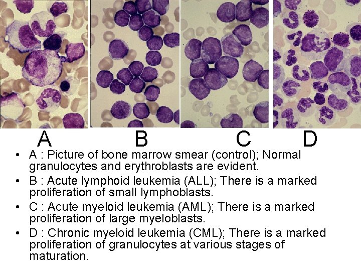 A B C D • A : Picture of bone marrow smear (control); Normal