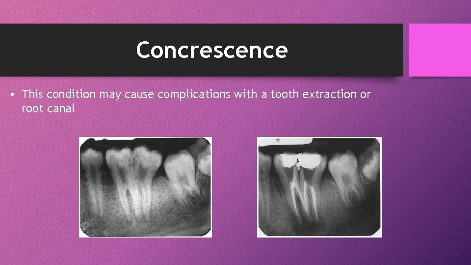Concrescence • This condition may cause complications with a tooth extraction or root canal