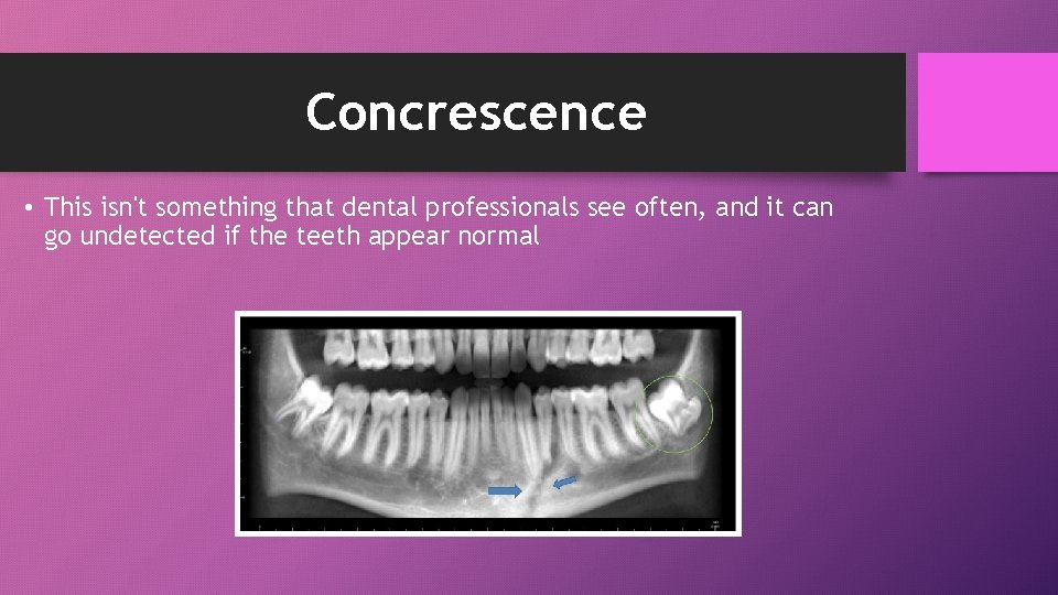 Concrescence • This isn't something that dental professionals see often, and it can go