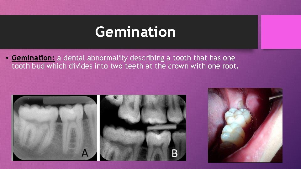 Gemination • Gemination: a dental abnormality describing a tooth that has one tooth bud