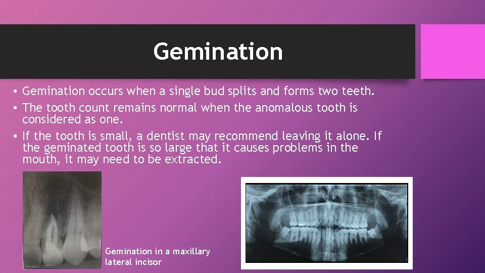 Gemination • Gemination occurs when a single bud splits and forms two teeth. •