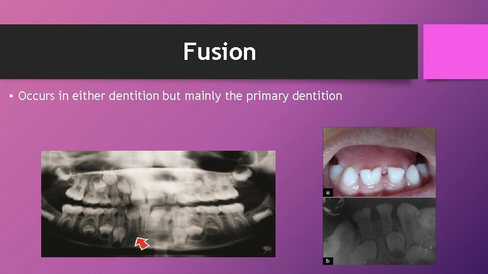 Fusion • Occurs in either dentition but mainly the primary dentition 