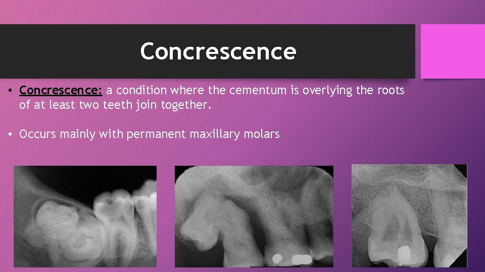 Concrescence • Concrescence: a condition where the cementum is overlying the roots of at