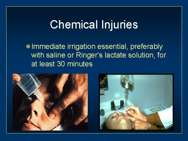 Chemical Injuries Immediate irrigation essential, preferably with saline or Ringer’s lactate solution, for at