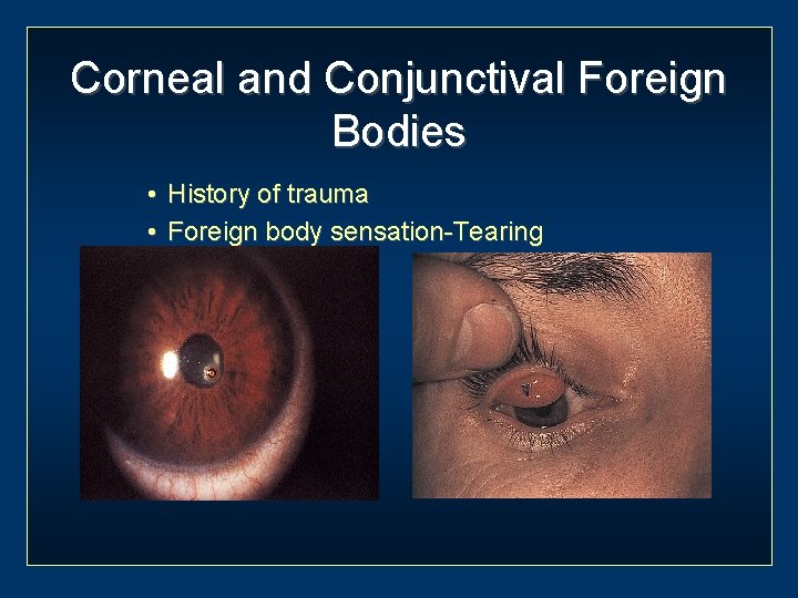Corneal and Conjunctival Foreign Bodies • History of trauma • Foreign body sensation-Tearing 
