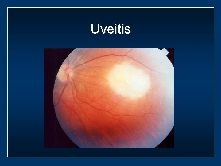 Uveitis 