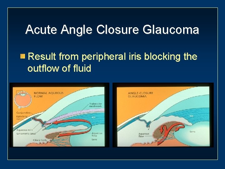 Acute Angle Closure Glaucoma Result from peripheral iris blocking the outflow of fluid 