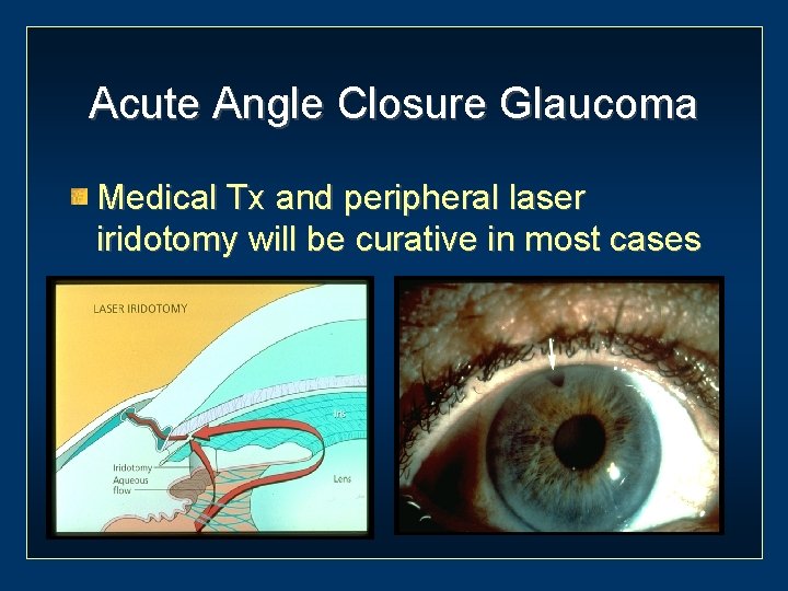 Acute Angle Closure Glaucoma Medical Tx and peripheral laser iridotomy will be curative in