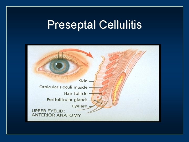 Preseptal Cellulitis 