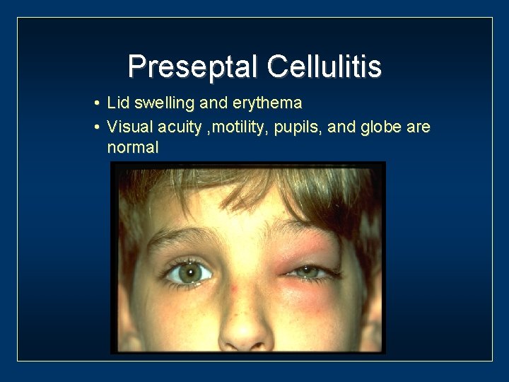 Preseptal Cellulitis • Lid swelling and erythema • Visual acuity , motility, pupils, and