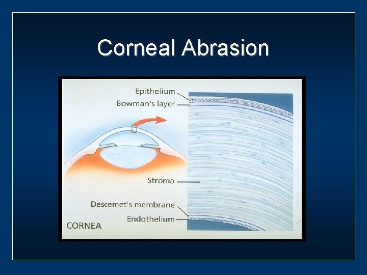 Corneal Abrasion 