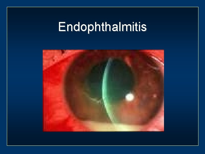 Endophthalmitis 