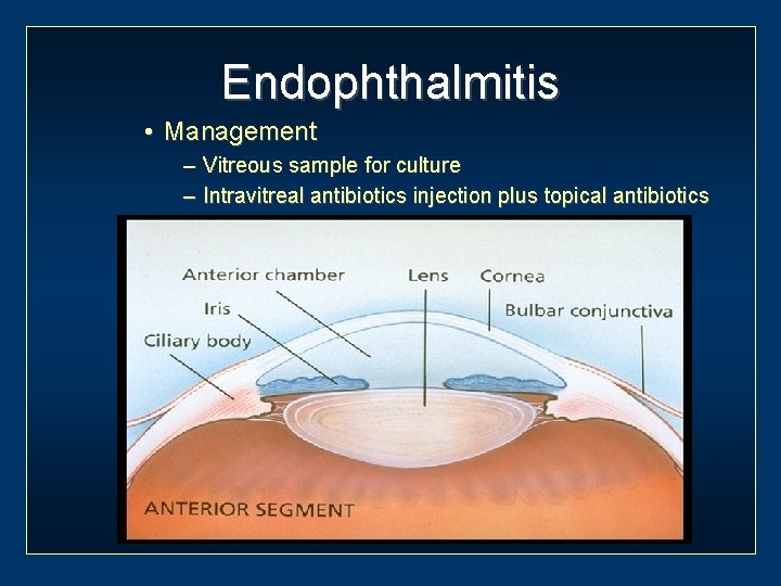 Endophthalmitis • Management – Vitreous sample for culture – Intravitreal antibiotics injection plus topical