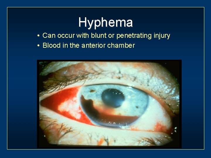 Hyphema • Can occur with blunt or penetrating injury • Blood in the anterior