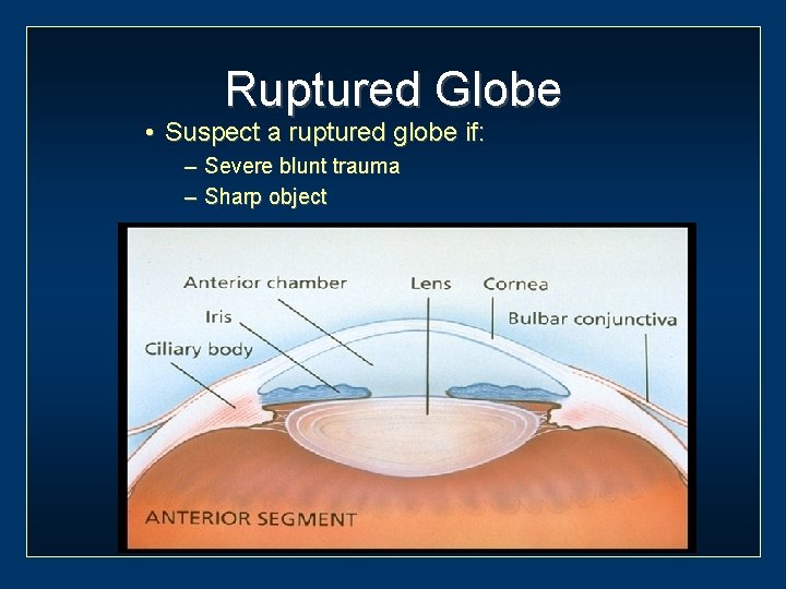 Ruptured Globe • Suspect a ruptured globe if: – Severe blunt trauma – Sharp