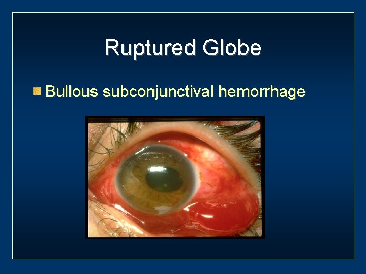 Ruptured Globe Bullous subconjunctival hemorrhage 