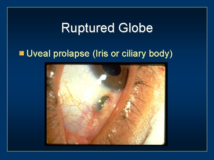 Ruptured Globe Uveal prolapse (Iris or ciliary body) 