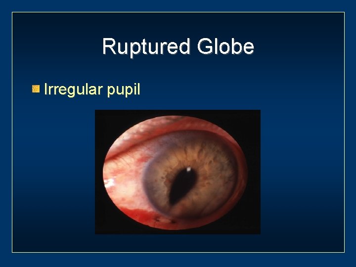 Ruptured Globe Irregular pupil 