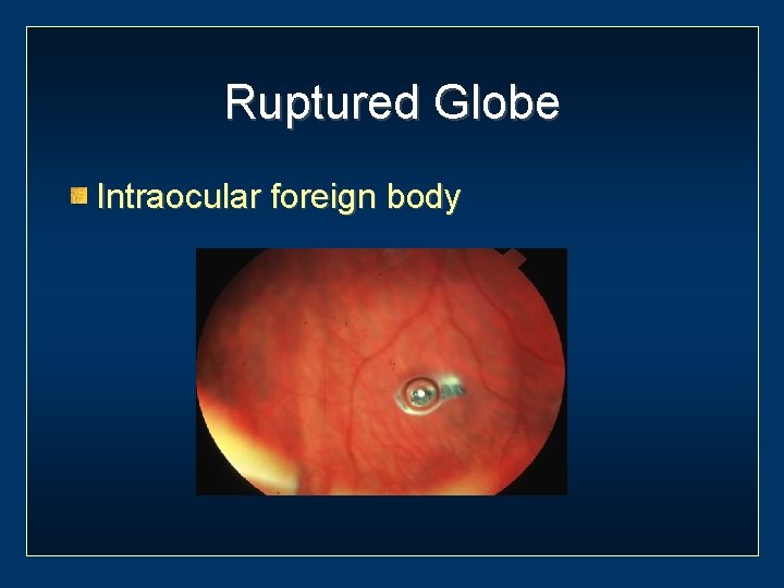 Ruptured Globe Intraocular foreign body 