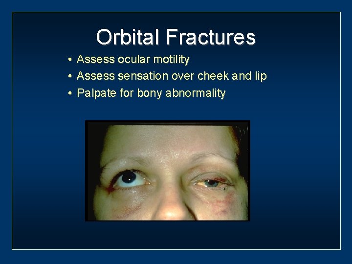 Orbital Fractures • • • Assess ocular motility Assess sensation over cheek and lip