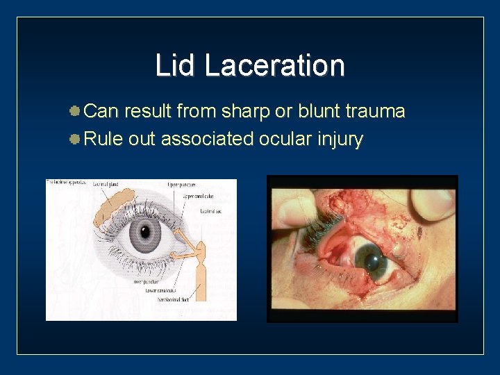Lid Laceration Can result from sharp or blunt trauma Rule out associated ocular injury