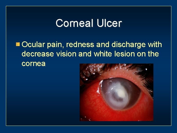 Corneal Ulcer Ocular pain, redness and discharge with decrease vision and white lesion on