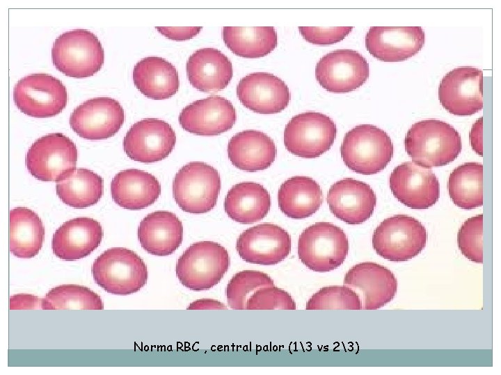 Norma RBC , central palor (13 vs 23) 