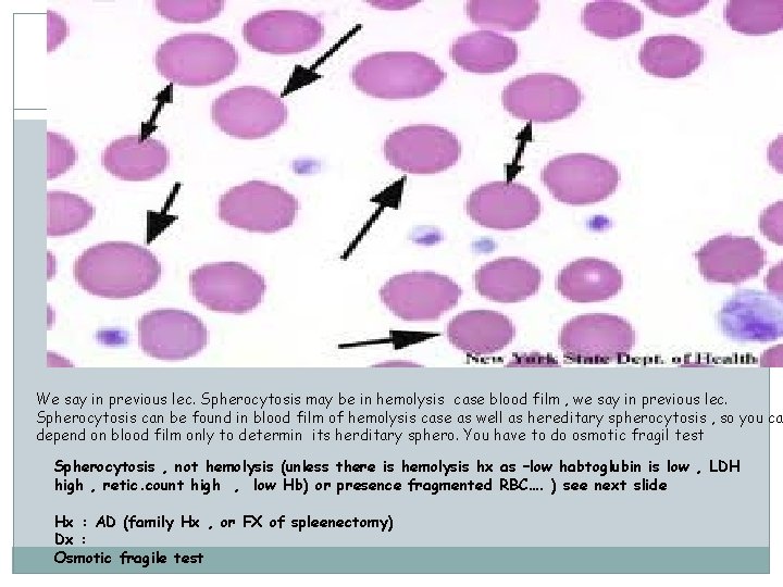 We say in previous lec. Spherocytosis may be in hemolysis case blood film ,
