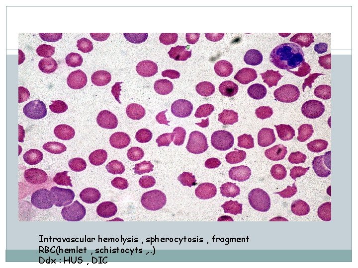 Intravascular hemolysis , spherocytosis , fragment RBC(hemlet , schistocyts , . . ) Ddx