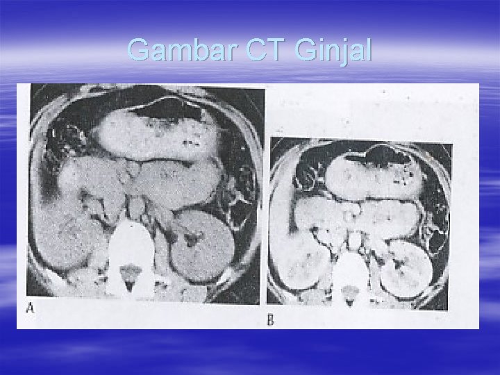 Gambar CT Ginjal 