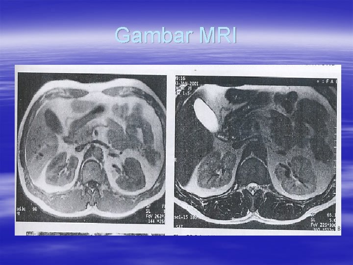 Gambar MRI 