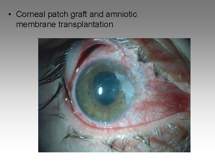  • Corneal patch graft and amniotic membrane transplantation 