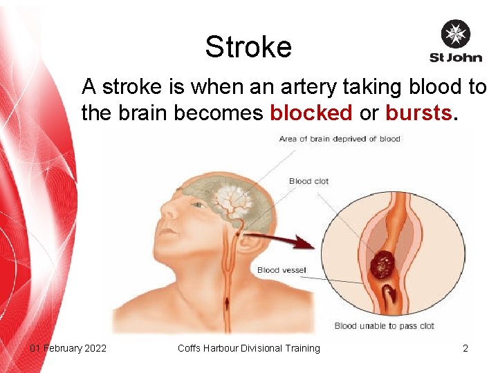 Stroke A stroke is when an artery taking blood to the brain becomes blocked