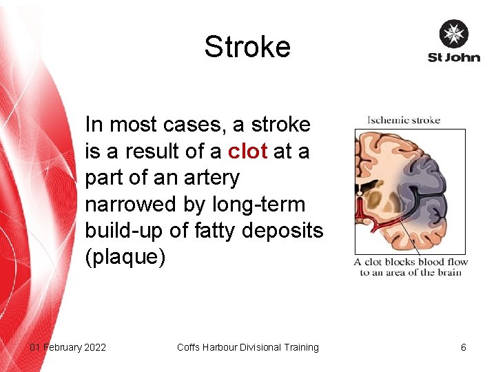 Stroke In most cases, a stroke is a result of a clot at a