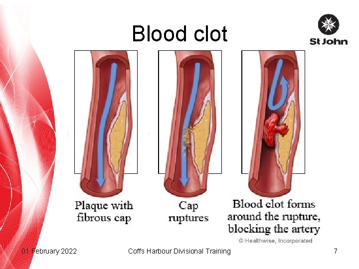 Blood clot 01 February 2022 Coffs Harbour Divisional Training 7 