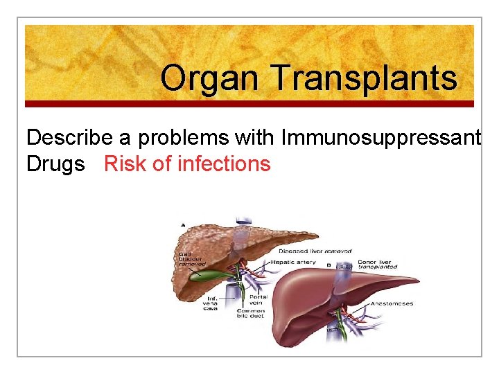 Organ Transplants Describe a problems with Immunosuppressant Drugs Risk of infections 