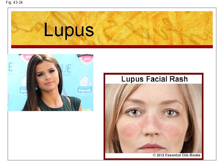 Fig. 43 -24 Lupus 