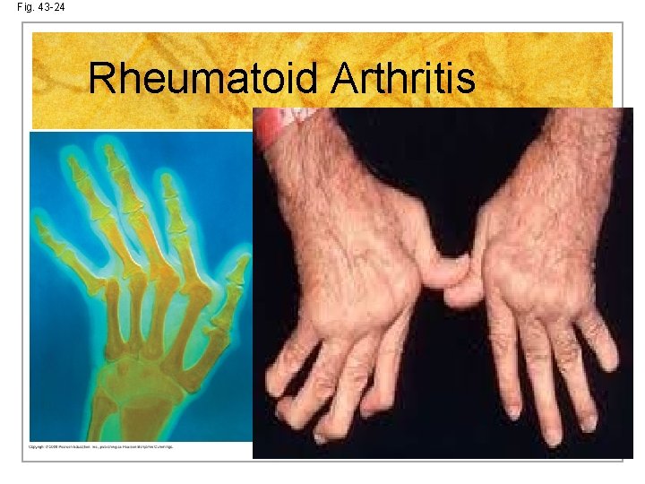Fig. 43 -24 Rheumatoid Arthritis 