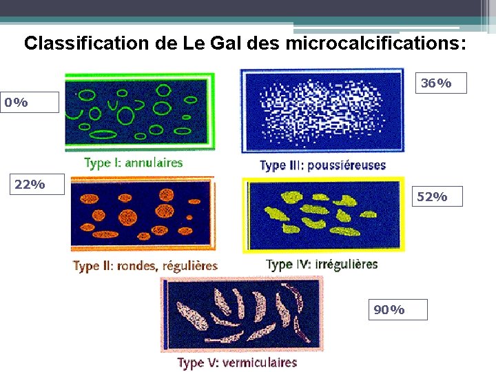 Classification de Le Gal des microcalcifications: 36% 0% 22% 52% 90% 