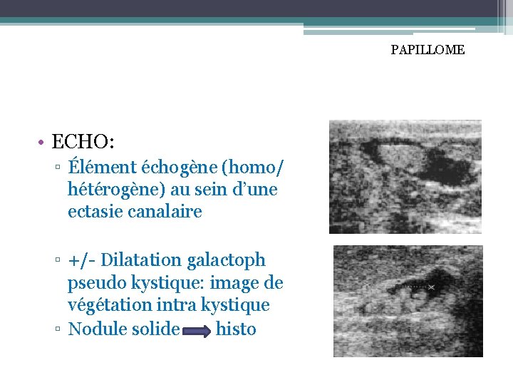PAPILLOME • ECHO: ▫ Élément échogène (homo/ hétérogène) au sein d’une ectasie canalaire ▫