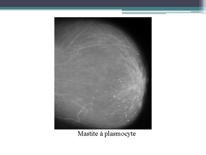 Mastite à plasmocyte 