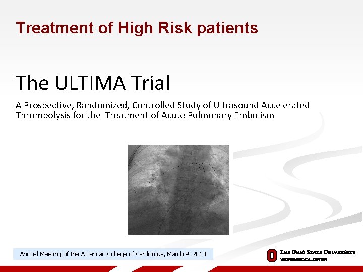 Treatment of High Risk patients The ULTIMA Trial A Prospective, Randomized, Controlled Study of