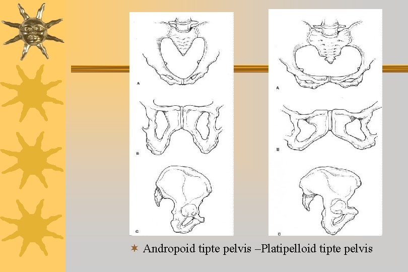 ¬ Andropoid tipte pelvis –Platipelloid tipte pelvis 