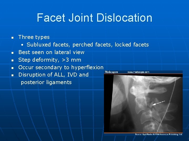 Facet Joint Dislocation n n Three types • Subluxed facets, perched facets, locked facets