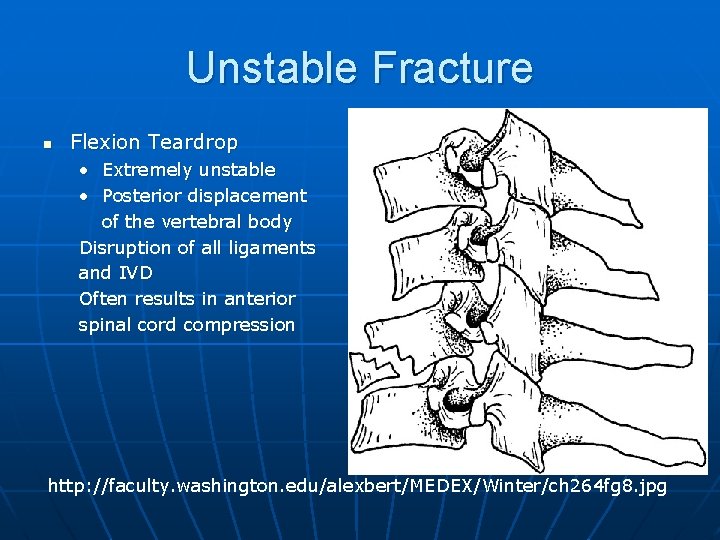 Unstable Fracture n Flexion Teardrop • Extremely unstable • Posterior displacement of the vertebral