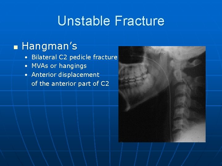 Unstable Fracture n Hangman’s • Bilateral C 2 pedicle fracture • MVAs or hangings